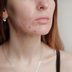 The 10 Worst Myths About Adult Acne