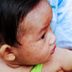 Are Measles Coming Back? What You Need to Know