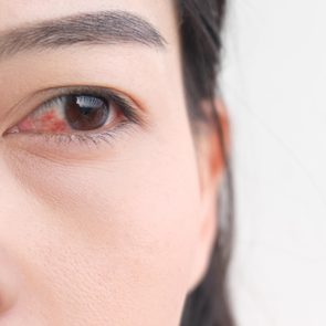 woman conjunctivitis pink eye