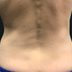 Does CoolSculpting Work? Here's What Happened When I Tried It