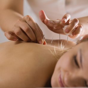 The doctor sticks needles into the woman's body on the acupuncture - close up