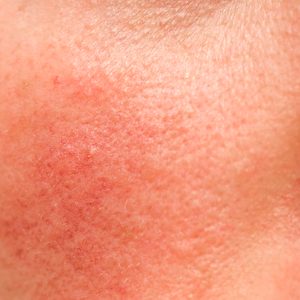 rosacea on face