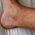 Have a Severe Reaction to a Bug Bite? It Could Be Papular Urticaria