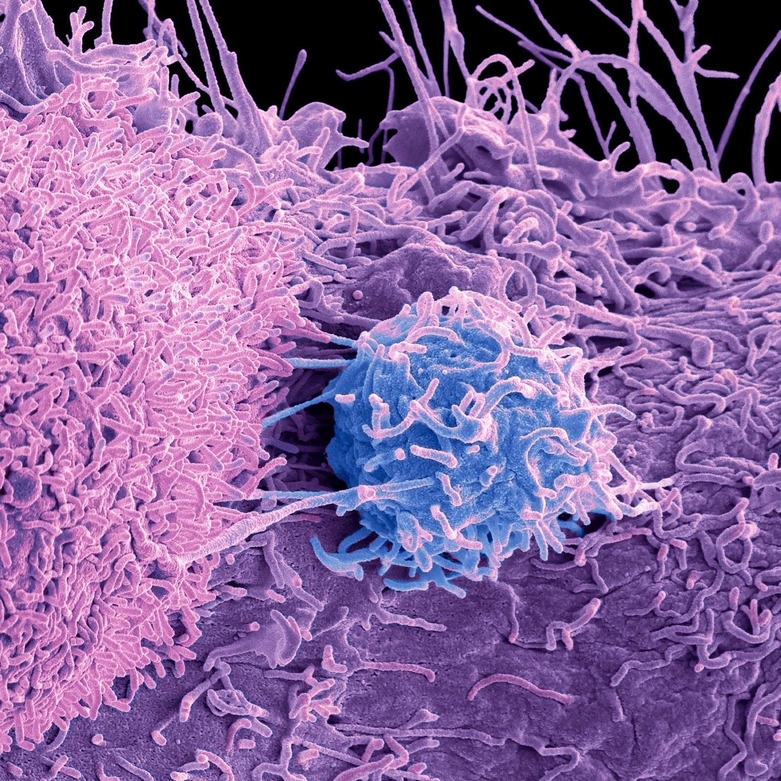 “Here’s How I Knew I Had Prostate Cancer”: One Patient’s Story of Abruptly Elevated Markers