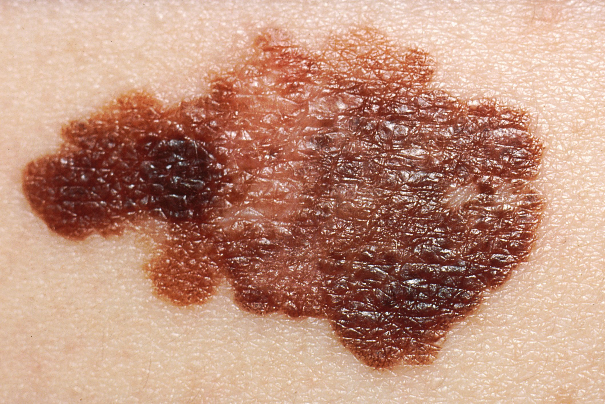 New Study: Low Levels of This Vitamin May Increase Melanoma Skin Cancer Risk